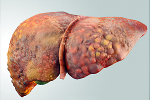 Fatty Liver KNOW MORE