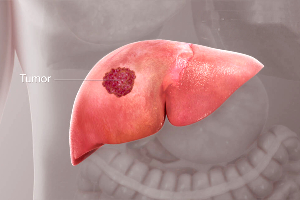 Liver CancerKNOW MORE