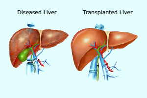 Liver transplantation surgery in Bangalore